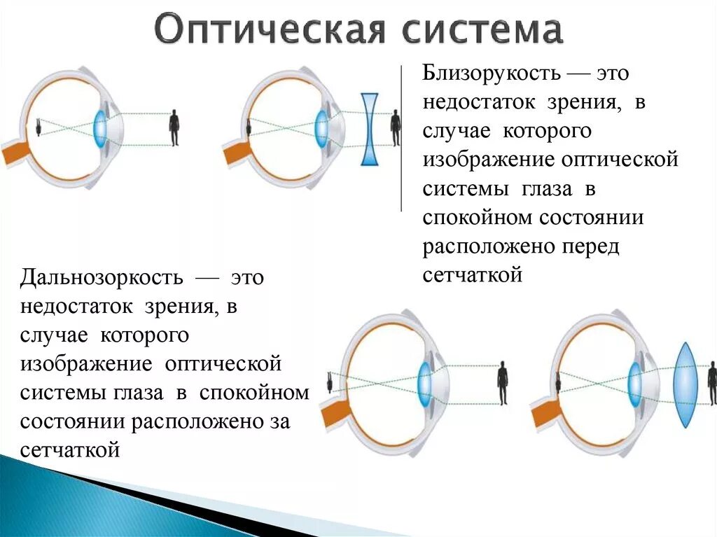 Дефекты зрения ответы. Оптическая система глаза при близорукости. Зрительная система дальнозоркость. Близорукость (истинная и ложная формы патологии). Оптическое строение глаза.