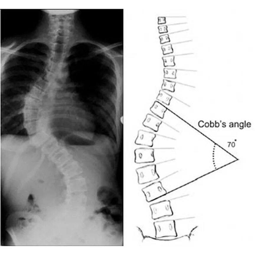 Угол Кобба 1 степени сколиоза. Сколиоз позвоночника рентген Кобба. Сколиоз 3 степени угол Кобба. Угол сколиоза по чаклину рентген. Угол кобба