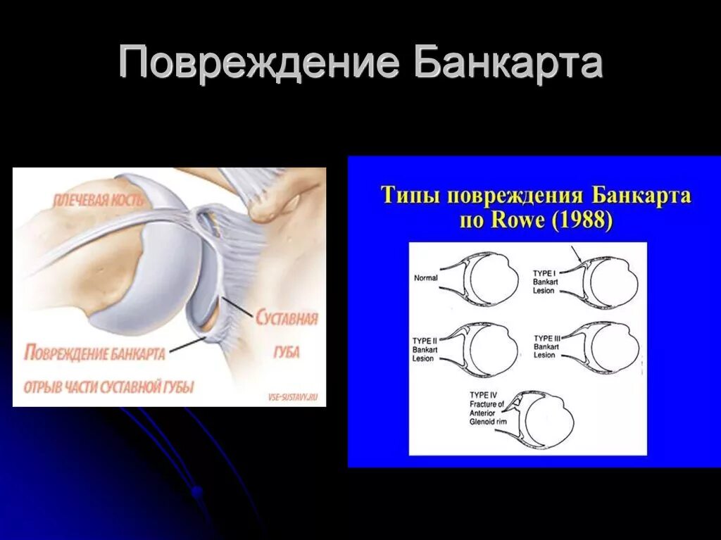 Повреждение губы плечевого сустава. Банкарта плечевого сустава. Костный Банкарта плечевого сустава. Банкарт плечевой сустав. Повреждение Банкарта и Хилл-Сакса плечевого сустава.