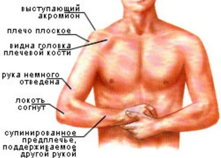 Плечо срывается