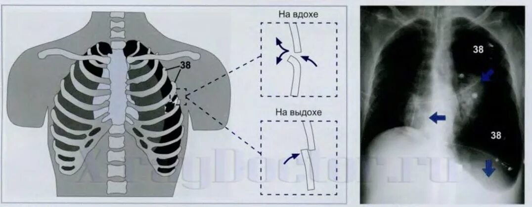 Скопление воздуха в грудной клетке. Скопление воздуха в грудной клетке. Пневмоторакс и ателектаз легкого. Скопление воздуха в грудной клетке. Смещение средостения при пневмотораксе.