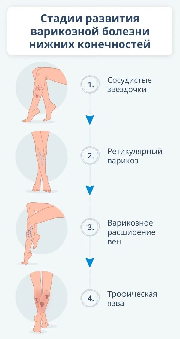 Варикозного расширения вен нижних конечностей у женщин. Варикозное расширение вен нижних конечностей патогенез. Варикозное расширение вен нижних конечностей стадии. Варикозная болезнь вен нижних конечностей стадии. Варикозное расширение вен нижних конечностей стадии развития.