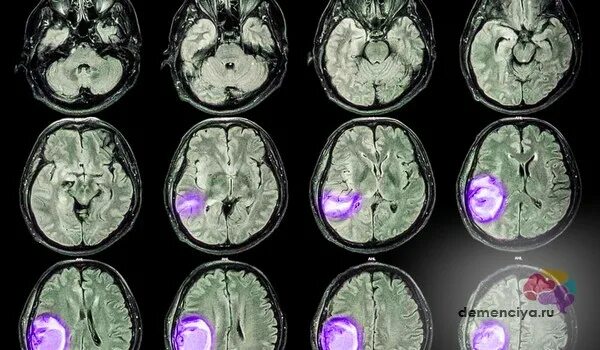 Рак мозга степени. Опухоль головного мозга глиобластома 4 стадия. Глиобластома, неоперабельная опухоль головного мозга.. Неоперабельная опухоль головного мозга 4 степени.