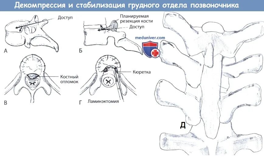 Декомпрессия и стабилизация позвоночника. Декомпрессия позвонков. Декомпрессия позвоночного канала. Операция декомпрессия позвоночного канала.