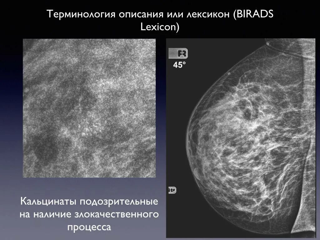 Фиброаденоматоз bi. Плеоморфные микрокальцинаты в молочной. Протоковые кальцинаты молочных желез. Маммография раковые микрокальцинаты.