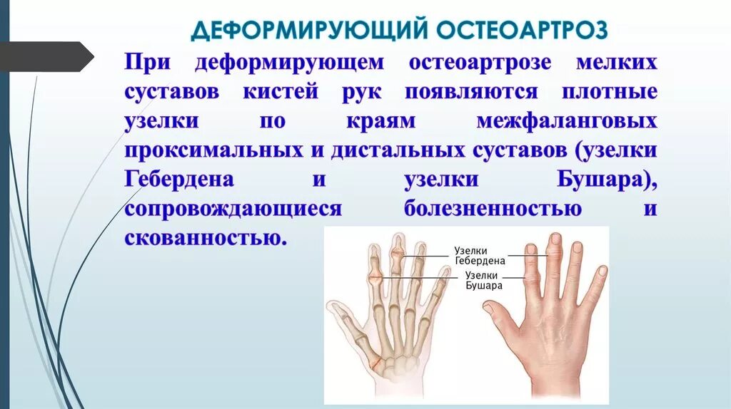 Остеоартроз проксимальных межфаланговых. Дистальные межфаланговые суставы кисти. Деформирующий остеоартроз межфаланговых суставов кистей. Деформация межфаланговых суставов.