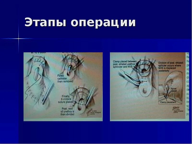 Простатэктомия после операции. Радикальная простатэктомия этапы операции. Уретеролитотомия этапы операции. Схема операции простатэктомии.