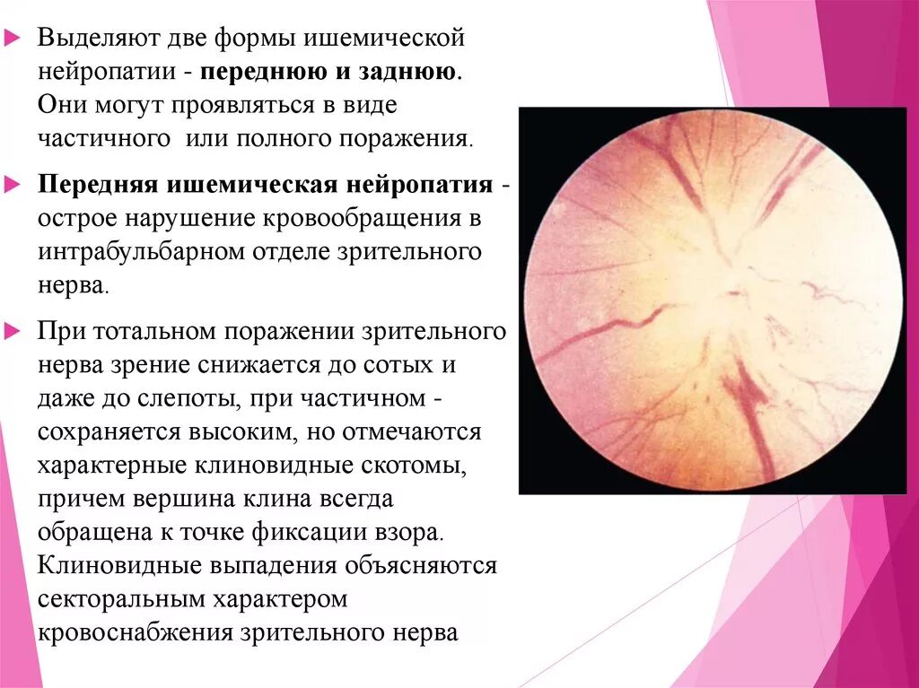 Задняя ишемическая нейрооптикопатия лечение. Глаукомная нейрооптикопатия. Задняя ишемическая нейрооптикопатия. Передняя ишемическая нейрооптикопатия. Задняя ишемическая оптическая нейропатия.
