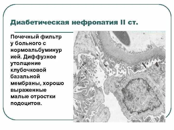 Диффузное утолщение