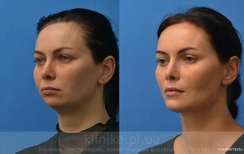 Операция по увеличению отзывы