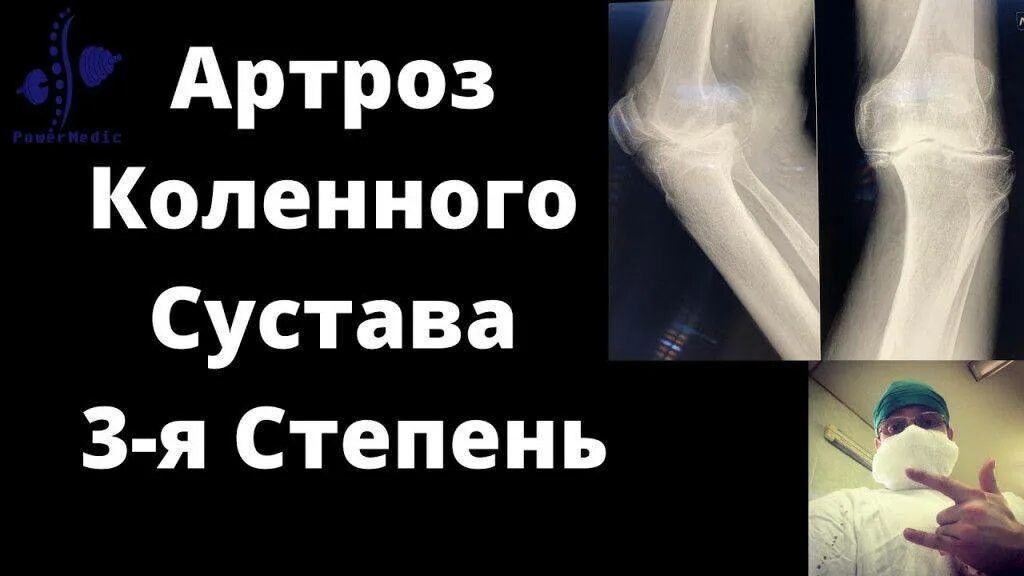 Гонартроз коленного сустава 3 степени операция. Артроз 3-й степени коленного сустава. степени артроза коленного сустава на кт. диета при гонартрозе коленного сустава 3 степени. артроз сустава 1 степени последствия.