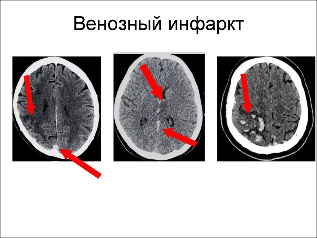 Венозный инфаркт головного мозга кт. Венозный ишемический инсульт на кт. Венозный инсульт головного мозга кт. Ишемический геморрагический венозный инсульт. Церебрального тромбоза