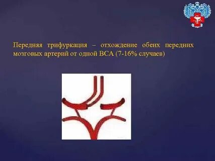 Трифуркация внутренней сонной артерии