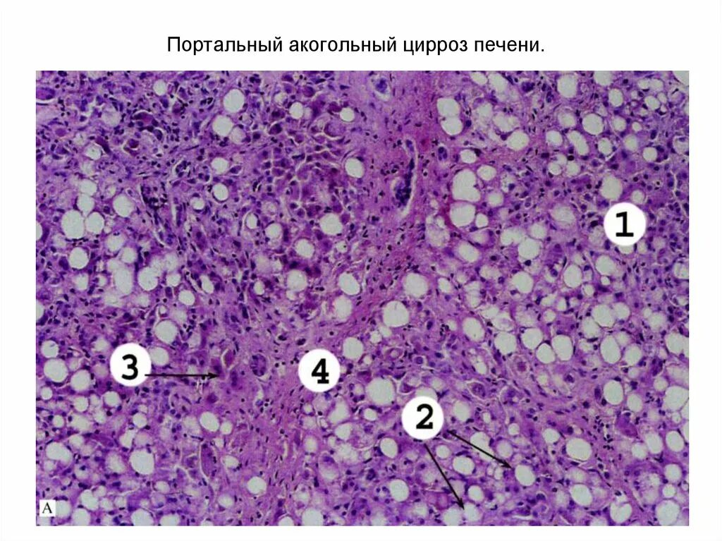 Печень микропрепарат описание. Монолобулярный цирроз патанатомия. Алкогольный портальный цирроз печени микропрепарат. Патологическая анатомия при циррозе печени. Постнекротическийцирроз микропрепарат.