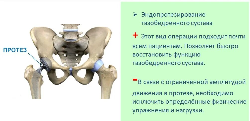 Эндопротез тазобедренного сустава компоненты. Протез тазобедренный сустав тазобедренного сустава. Протез головки шейки бедра. Эндопротезирование тазобедренного сустава ход операции.