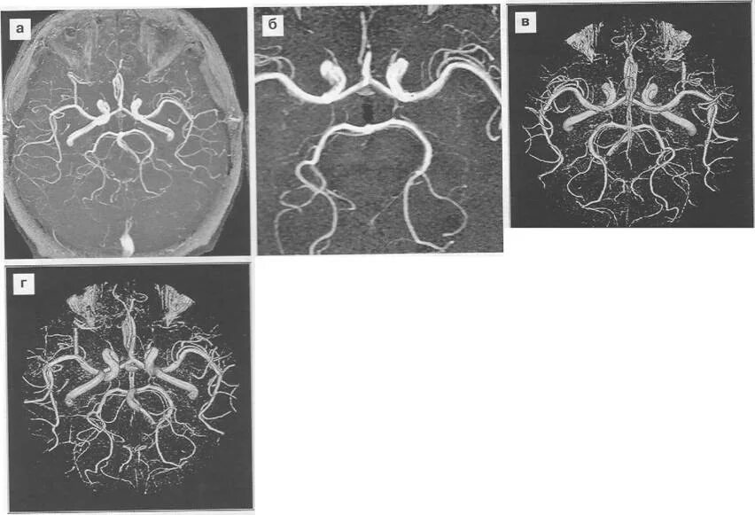 Виллизиев круг анатомия на кт. Гипоплазия позвоночной артерии кт. Гипоплазия правой позвоночной артерии на кт. Аплазия правой позвоночной артерии. Гипоплазия правой артерии головного мозга