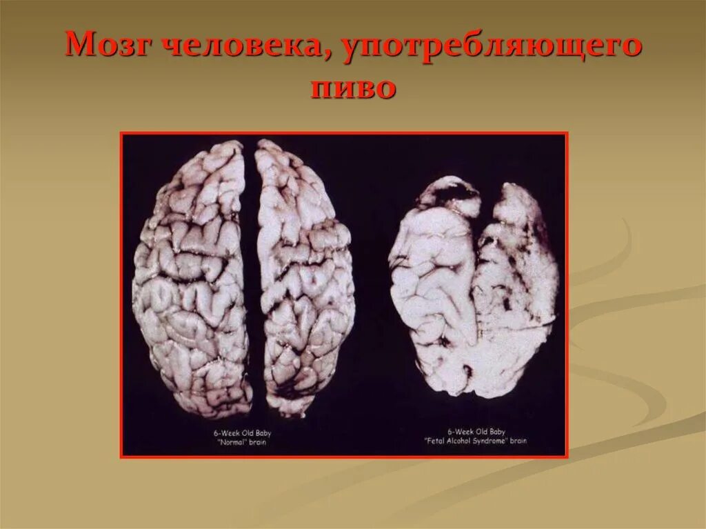 Состояние пьющего человека. Мозг здорового и пьющего человека. мозг пьющего и непьющего человека. головной мозг алкоголика.