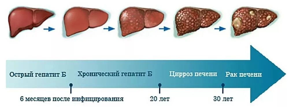 После let. Хронический гепатит б цирроз печени. Цирроз печени стадии гепатит с. Заболевания печени (острые и хронические гепатиты, циррозы печени):.