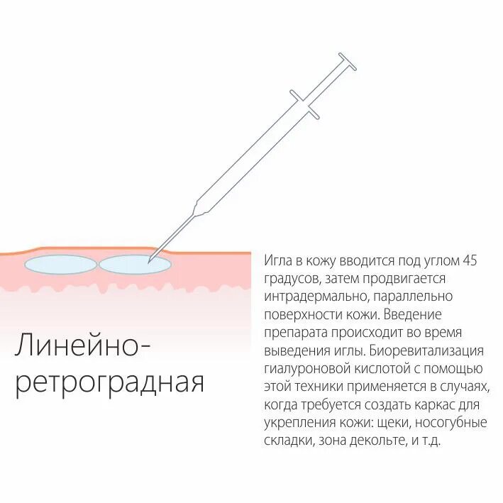 Внутрикожная глубина введения иглы. Схема инъекций при биоревитализации. Биоревитализация папульная техника введения. Техника линейно-ретроградная мезотерапия. Линейно ретроградная техника в мезотерапии.