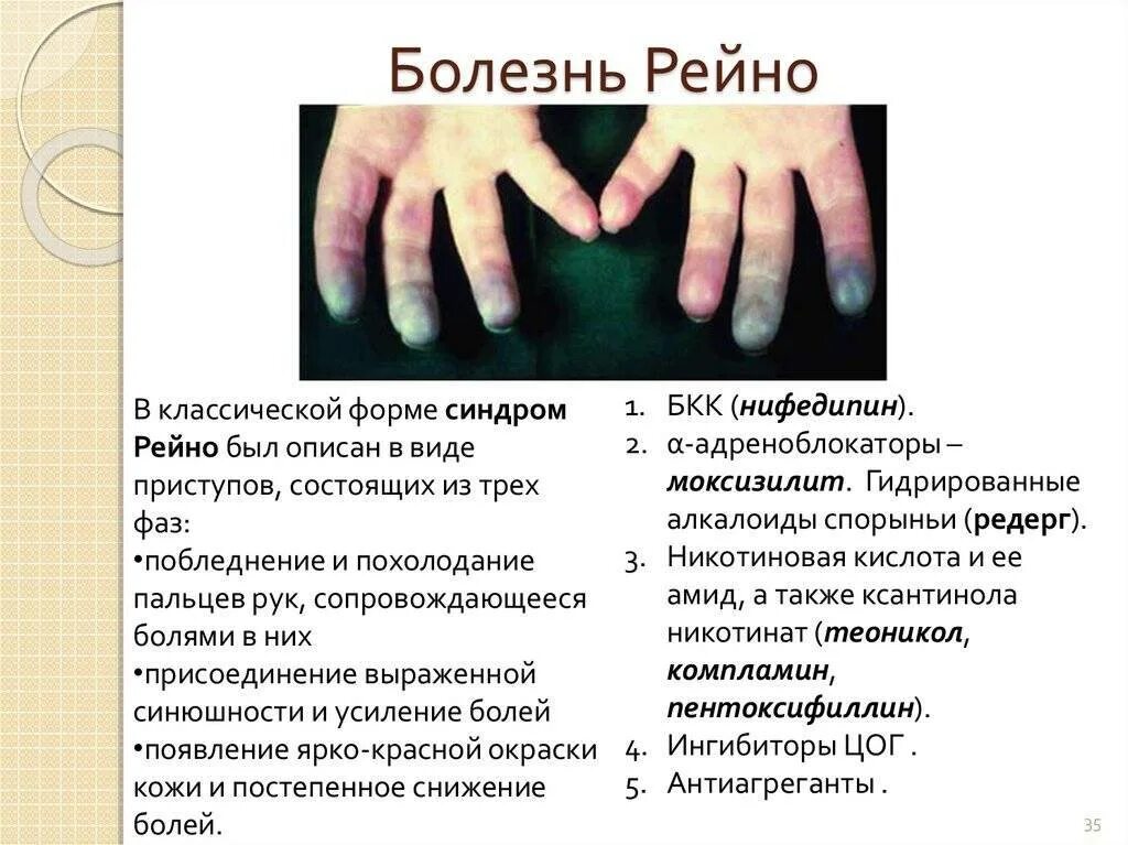 Вторичный синдром. Синдром рейно ангиоспастическая стадия. вазоспастический синдром рейно. симптомы, характерные для болезни рейно. синдром рейно первые симптомы.