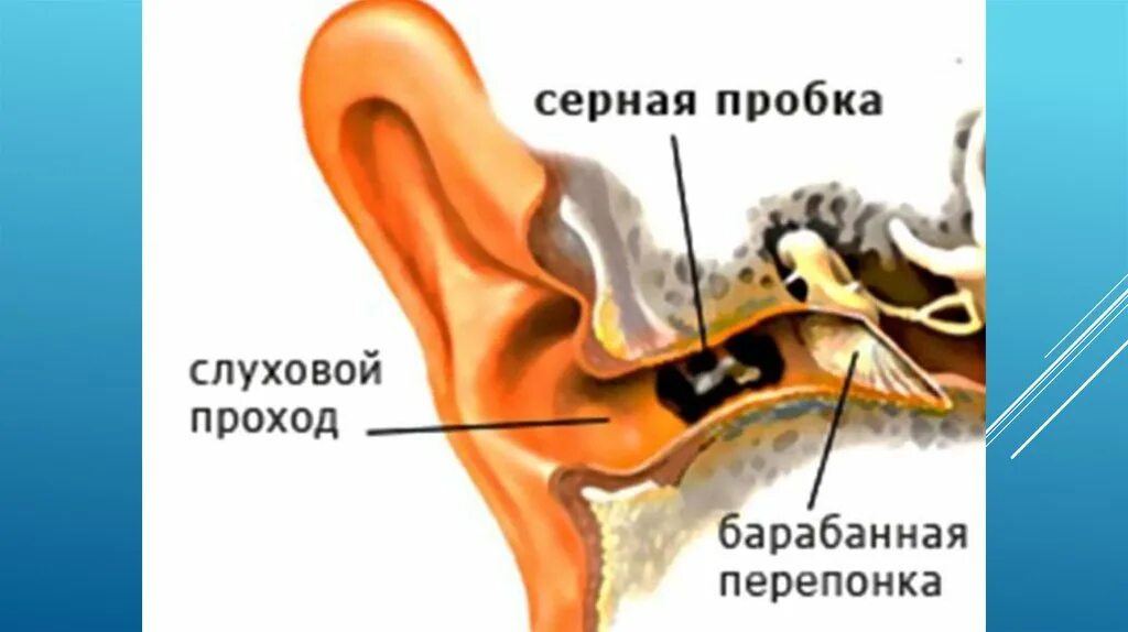 Почему у людей в ушах сера. Ушная сера в барабанной перепонке. серная пробка на барабанной перепонке. строение уха человека с пробкой. строение уха ушная пробка.