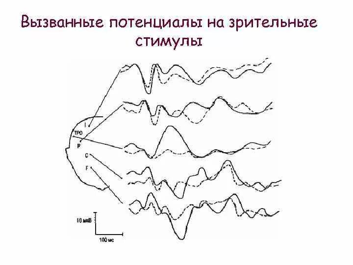 Потенциал ээг. Исследование вызванных потенциалов головного мозга. Зрительные вызванные потенциалы (ЗВП). Вызванные потенциалы ЭЭГ. P300 когнитивно вызванные потенциалы.