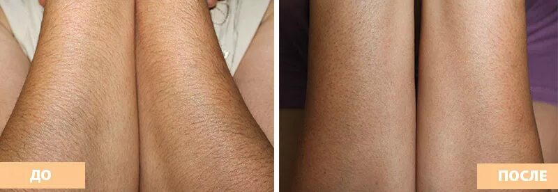 брить волосы после лазерной эпиляции. лазерная эпиляциябикири. брить волосы после лазерной эпиляции. лазерная эпиляция до и после. лазерная эпиляция волос.