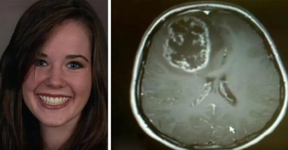 мне сказали у меня опухоль мозга. мне сказали у меня опухоль мозга. заворотнюк анастасияолезнь. девушка с опухоль головного мозга лицо. мне сказали у меня опухоль мозга.