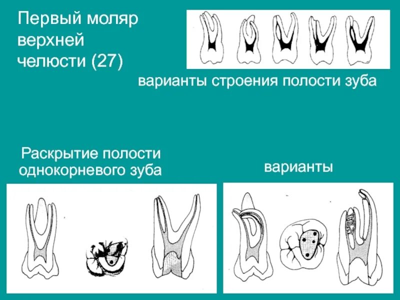 Первый моляр верхней челюсти. 1 Моляр верхней челюсти анатомия. 6 Моляр верхней челюсти. Первый верхний моляр анатомия. Строение моляра верхней челюсти.