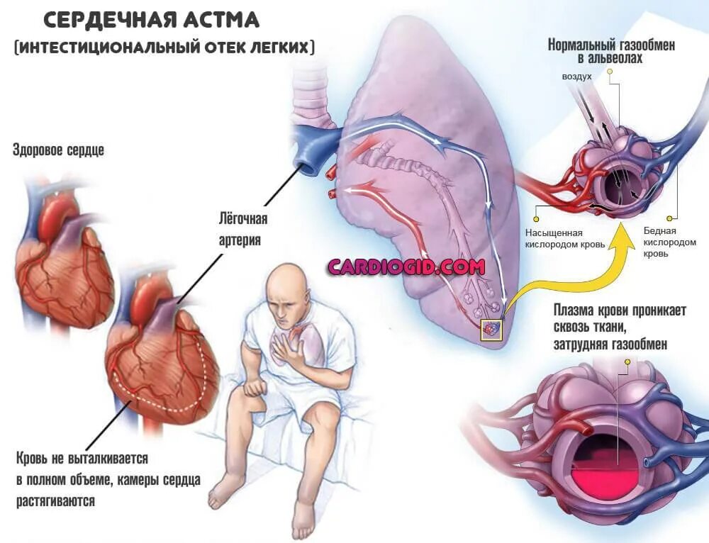Как снять сердечную недостаточность. Сердечная астма проявление недостаточности. Патогенез приступа сердечной астмы. Сердечная астма клинические проявления. Сердечная астма механизм развития.