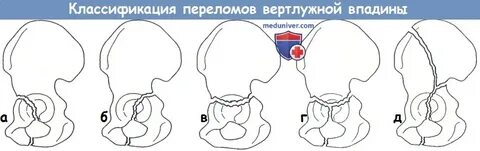 Лечение перелома вертлужной впадины