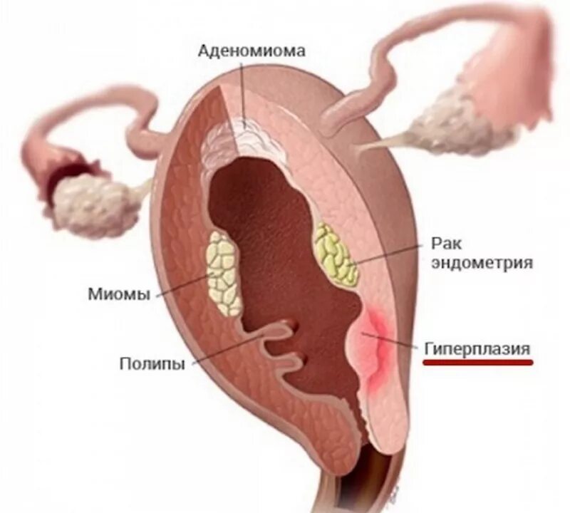 Гиперплазия в пременопаузе. Гиперплазия эндометрия матки что это. Миома субсерозная субмукозная. Субмукозная миома матки. Симптомная миома матки.