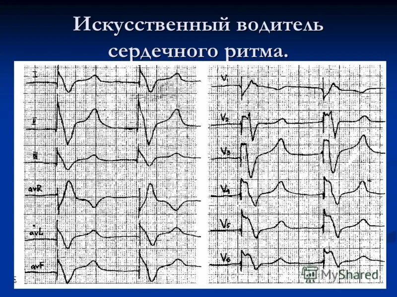 Искусственный водитель ритма. Искусственный водитель ритма