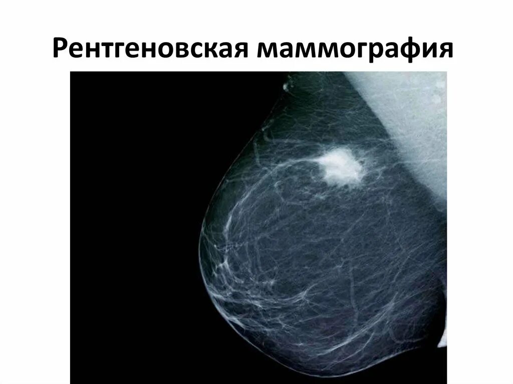 Фиброаденома молочной железы что это лечение. Фиброаденома молочной железы маммограмма. Обызвествленная фиброаденома молочной железы рентген. Фиброаденома молочной железы маммография. Рентгеновская маммография фиброаденомы молочной железы.