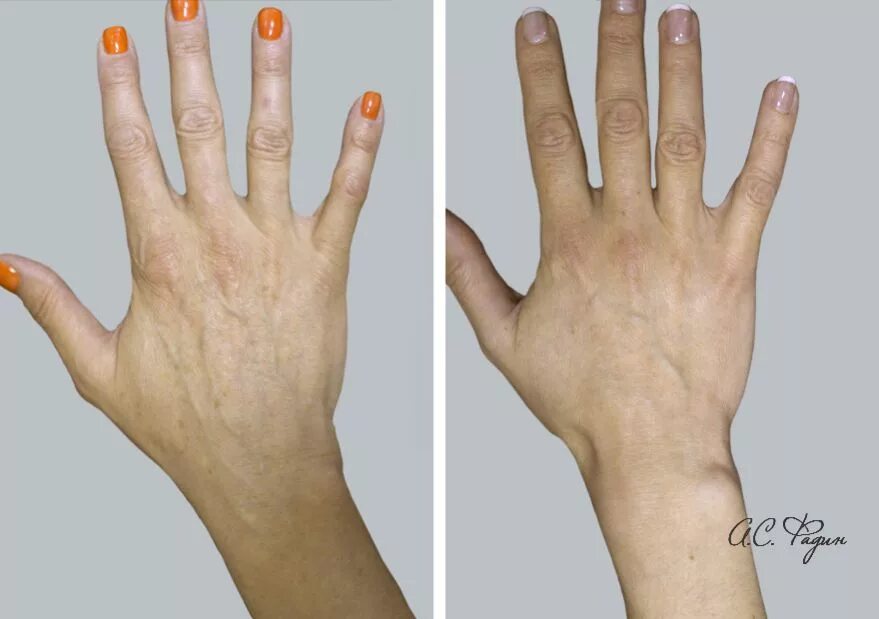 Изменение формы руки. Пластическая операция кистей рук.