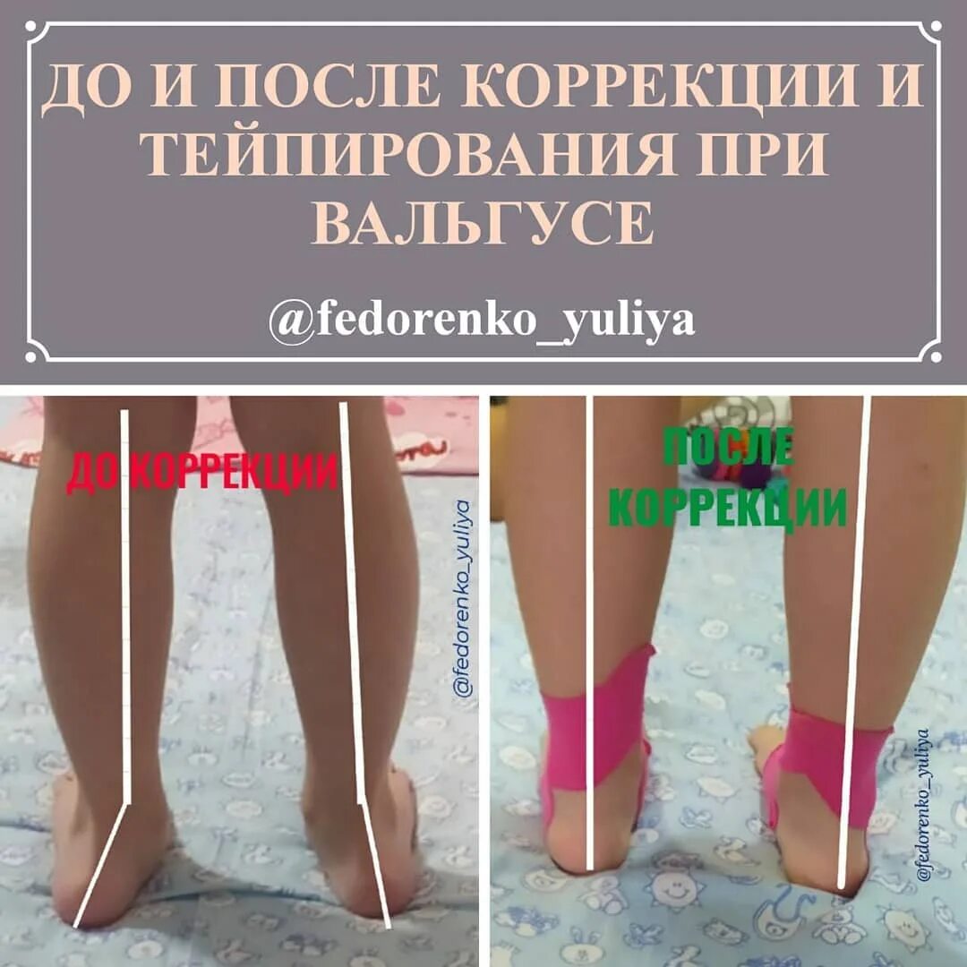 Варус стопы тейпирование. Тейпирование плосковальгусной стопы. Тейпирование вальгусной стопы. Тейпирование при плоскостоп. Тейпирование при вальгусе у детей.