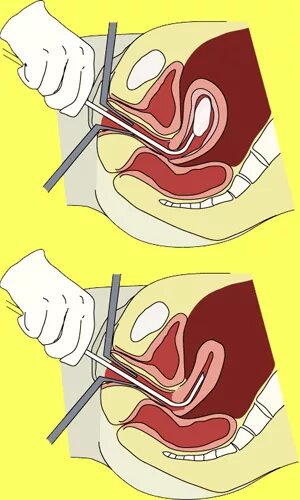 Кюретаж в гинекологии