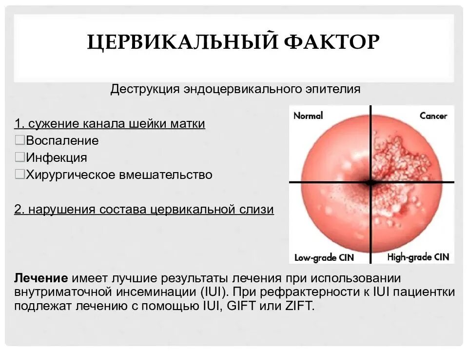 Какая матка при воспалении. Цервикальный канал шейки. Наружное отверстие цервикального канала. Цервикальный канал матки.