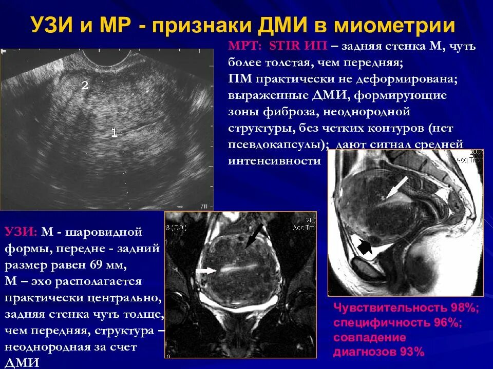 Структура миометрия по УЗИ. Диффузные изменения миометрия аденомиоз