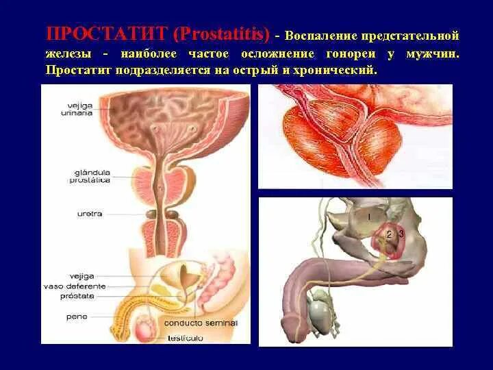 Воспалился простатит. Воспаление предстательной железы. Воспаление предстательной железы у мужчин. Воспалилась предстательная железа. Гонорея предстательной железы.