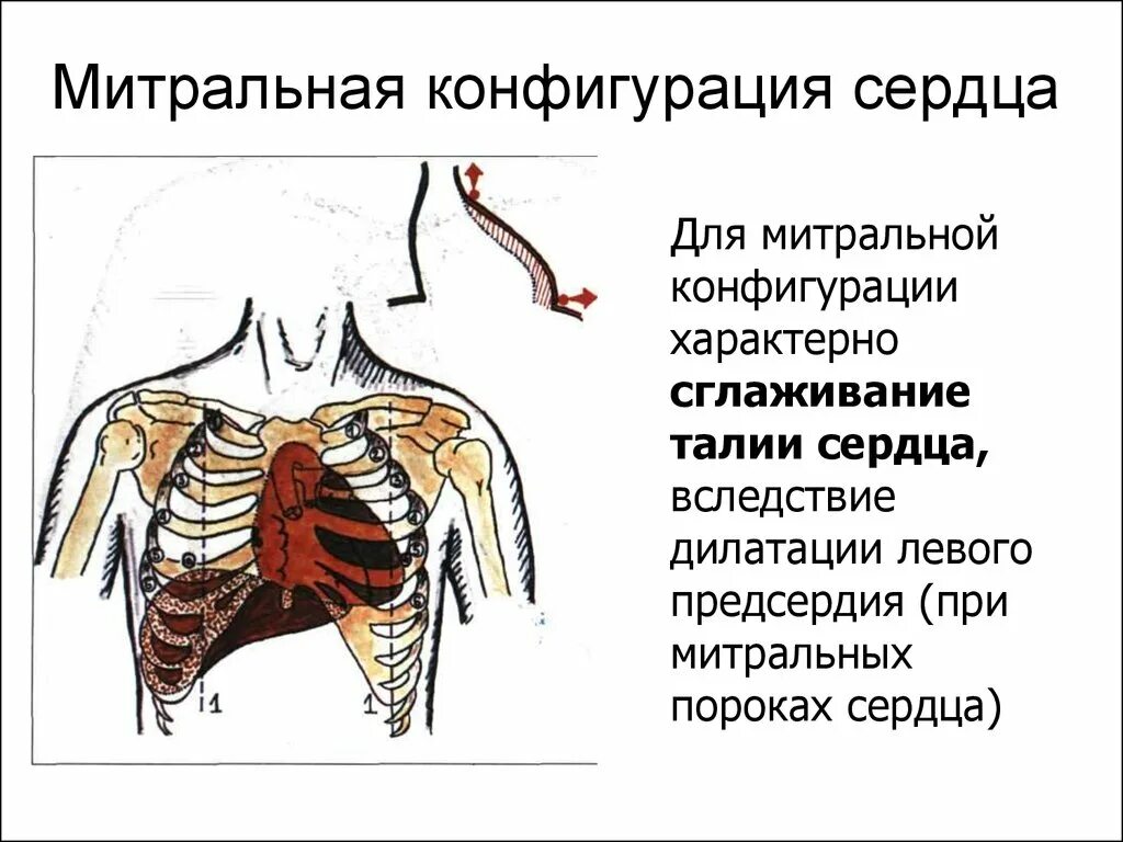 Конфигурации сердца. Конфигурация относительной сердечной тупости. митральная недостаточность конфигурация сердца. конфигурация сердца перкуссия. митральная и аортальная конфигурация сердца.