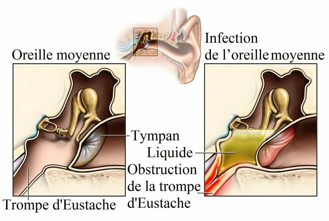 Евстахиит что это. Евстахиит что это. Евстахиит что это. Острый тубоотит симптомы. Евстахиит что это.