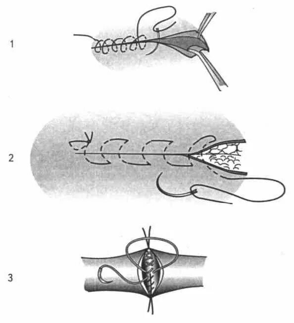 Техника наложения хирургических швов. Шов матрасный хирургический. Портняжный шов хирургия. Хирургический шов восьмерка.