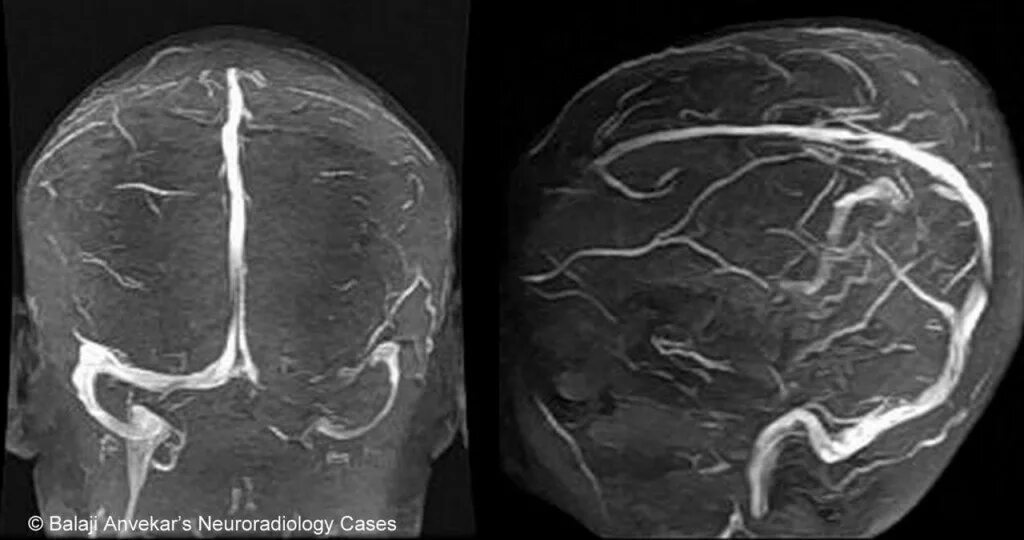 Гипоплазия левой поперечного синуса. Гипоплазия левого поперечного синуса. Мрт. Гипоплазия левого поперечного синуса головного мозга на мрт. Гипоплазия поперечного синуса справа. Гипоплазия правой артерии мозга