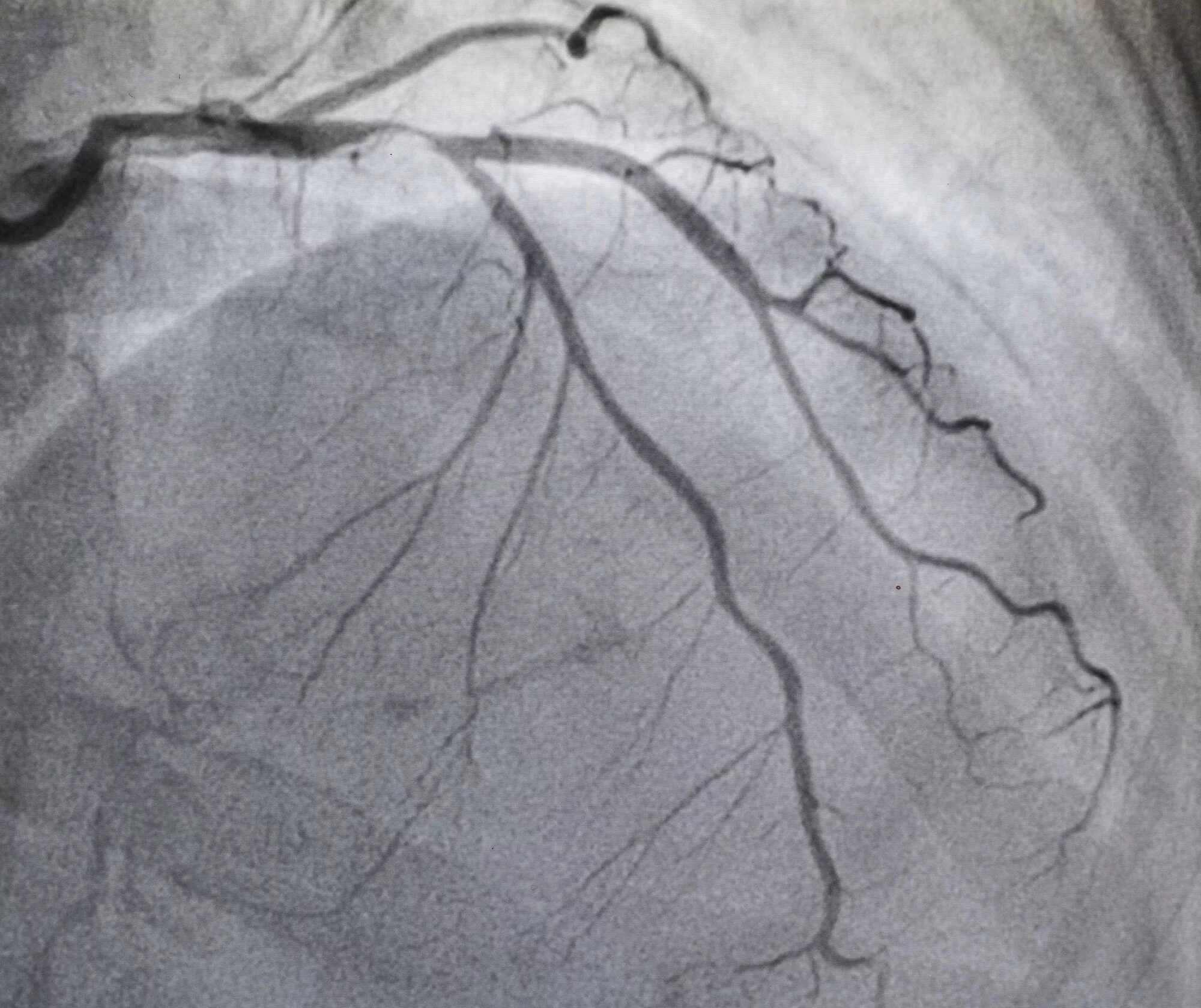 Ангиография коронарография. Рентгеноконтрастная коронарография. Коронароангиография ИБС. Коронарография рентген. Расширяет коронарные сосуды