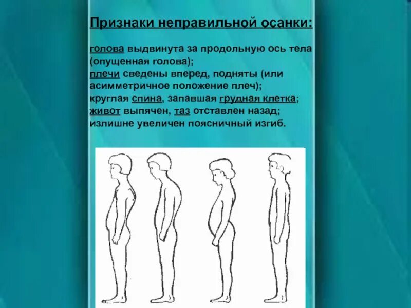 Выдвижение вперед. Признаки неправильной осанки. признаки не правильннойосанки. неправильная осанка головы. осанка с выдвинутой вперед головой.