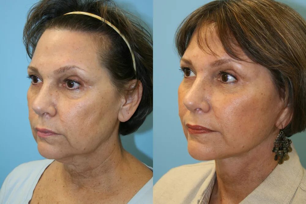 брыли под глазами. деформация овала лица. брыли под глазами. брыли под глазами. брыли под глазами.