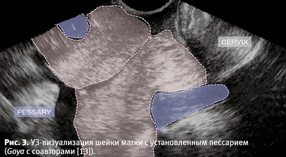 Шейка матки у беременных. Узи шейки матки с пессарием. кольцо шейки на узи.