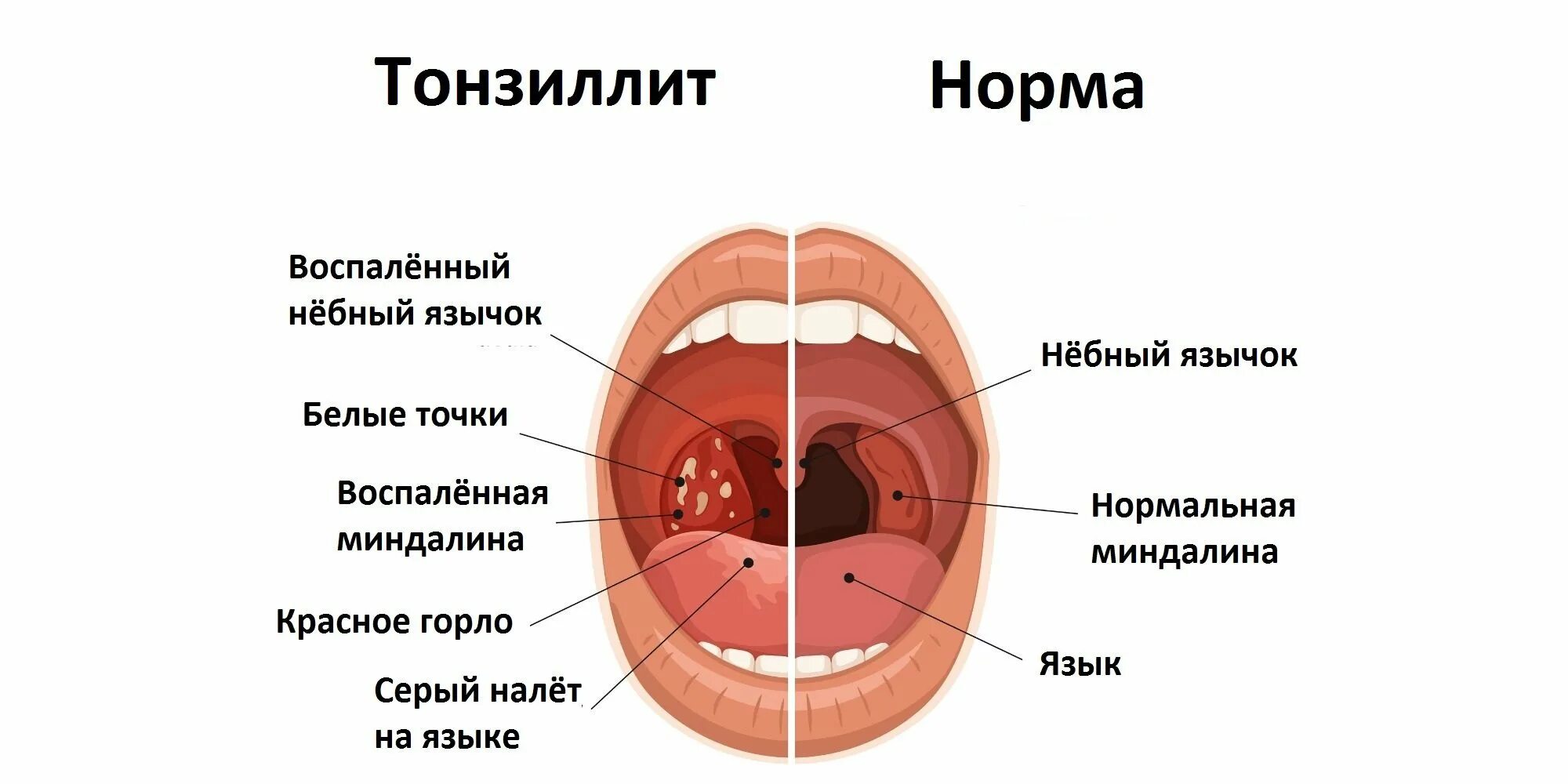 Небные миндалины хронический тонзиллит. Клинические симптомы тонзиллит. Хронический тонзиллит вид гланд. Что означает кровь во рту