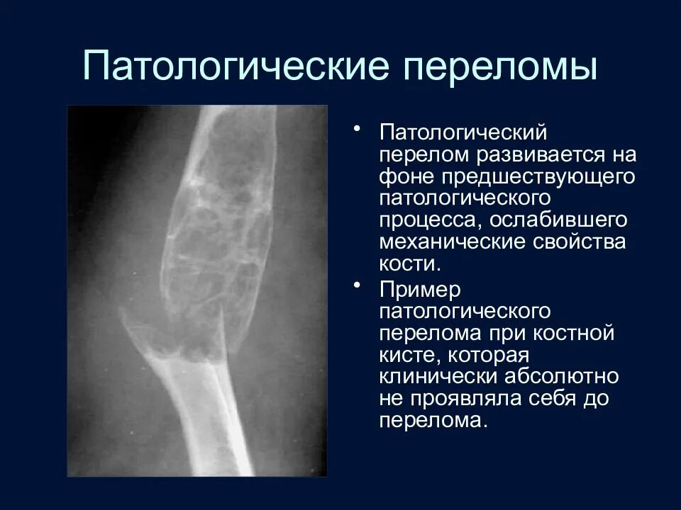 Патологический перелом бедра. Лучевая диагностика патологического перелома. патологический перелом бедренной кости метастазы. травматический вывих плечевой кости диагноз. патологические переломы костей.